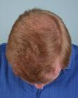 After Hair Transplant&nbsp;2 Sessions (Areas)
